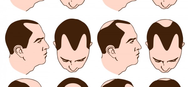 Is There A Male Pattern Baldness Cure